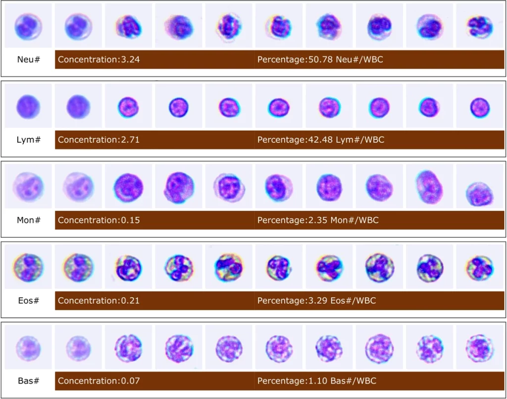 Galerías de neutrófilos, linfocitos, monocitos, eosinófilos y basófilos en un informe del Seamaty VM2